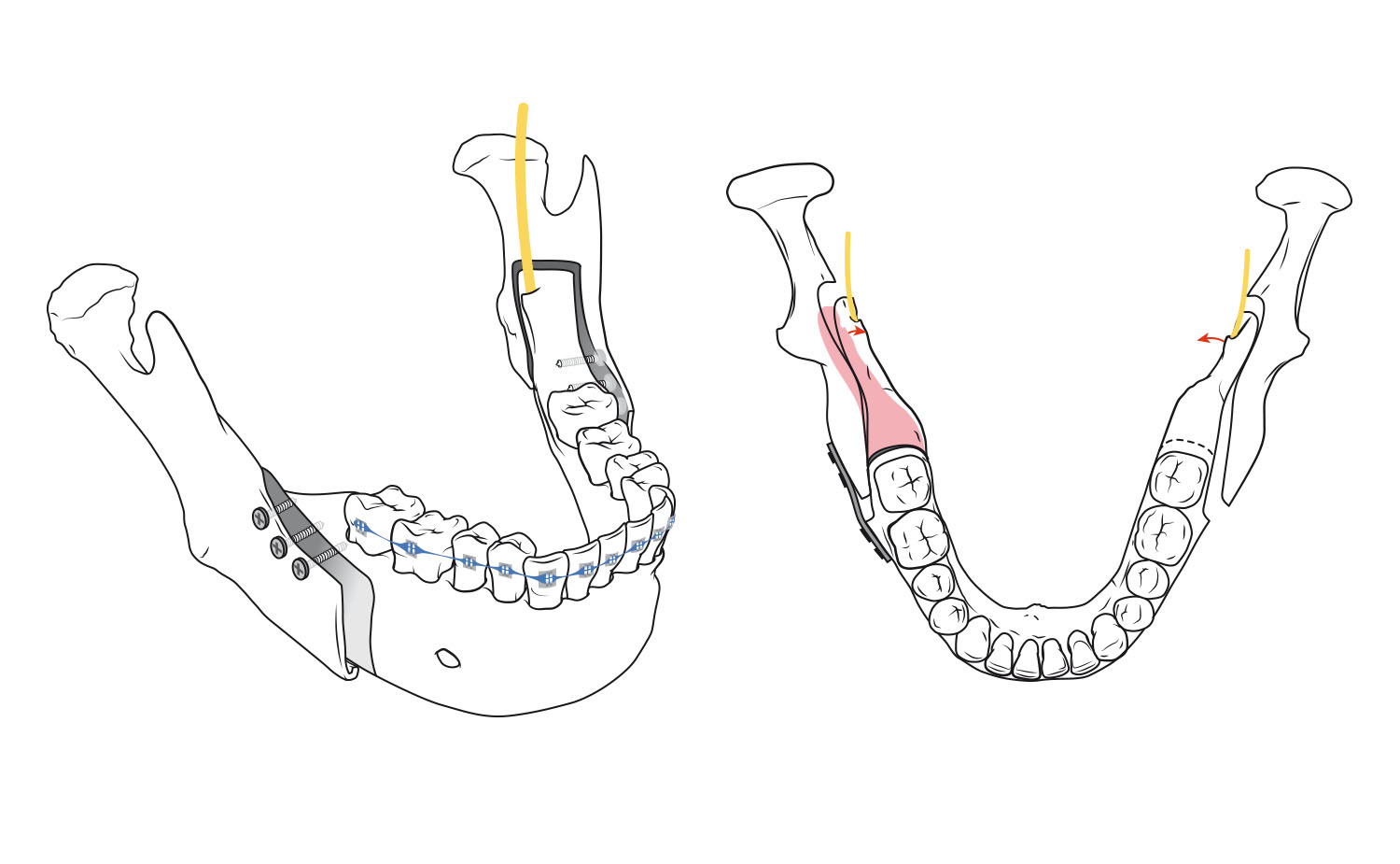 mandibular surgery