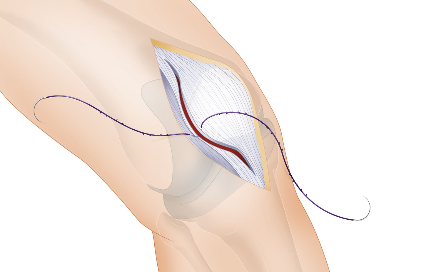 knee prosthetics