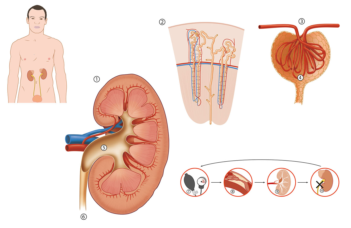 kidney fallure
